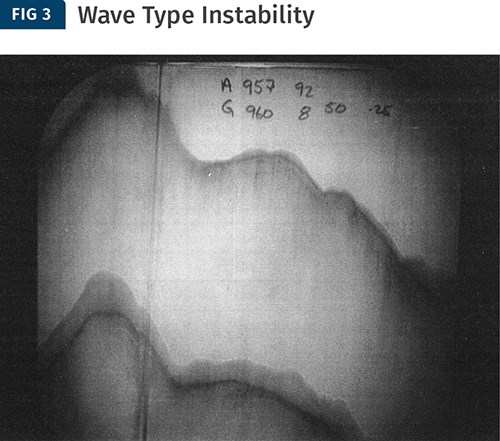 La inestabilidad interfacial en olas se ve comúnmente entre los materiales que tienen viscosidades elongacionales muy diferentes.
