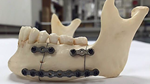 Additive Manufactured Fixation Plates Match Stiffness and Shape of Patient’s Jaw Bone