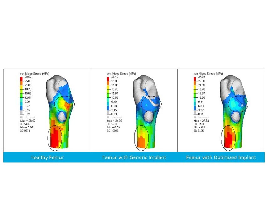 Altair simulation results showing stress shielding