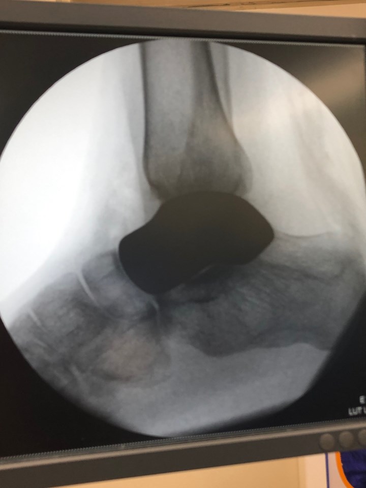 X ray of talus bone