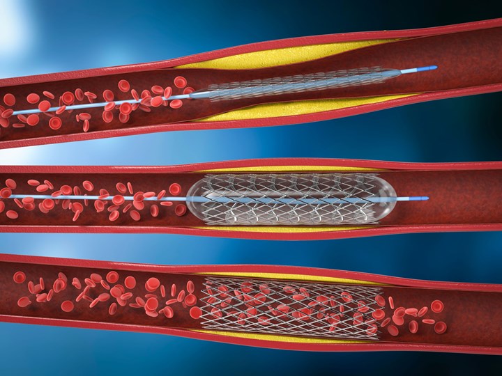 illustration of stents inside of arteries 