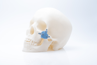 image of a facial bone implant on a faux skull