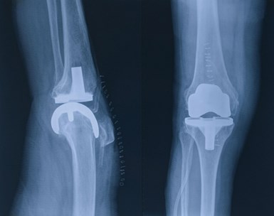 Un fémur que requiere un alto nivel de precisión debería ser escaneado análogamente o con CWS. Los rayos X muestran un implante de fémur.