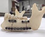 Additive Manufactured Fixation Plates Better Match Patient's Jaw Bone