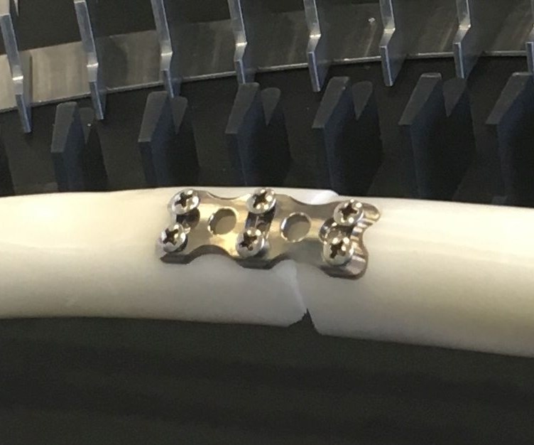 A curved bone plate is attached to a model femur via screws. The plate attached to the Femur was machined from 316 stainless on a Variaxis i-300 AWC five-axis machining center.  