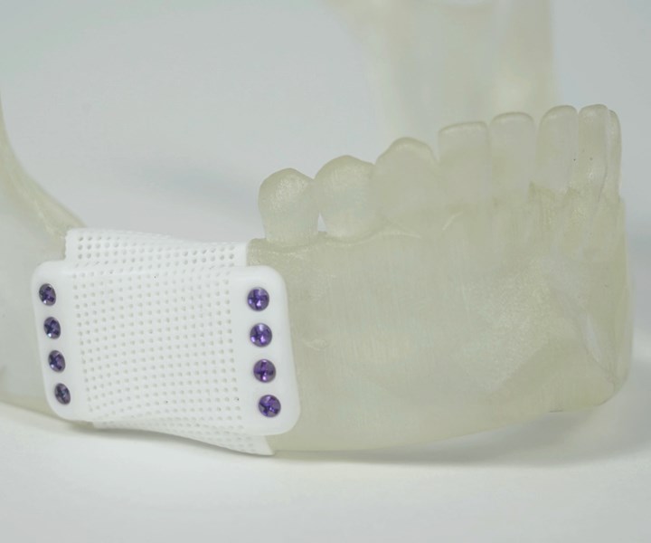 3d printed ceramic bone implants on a jaw model 