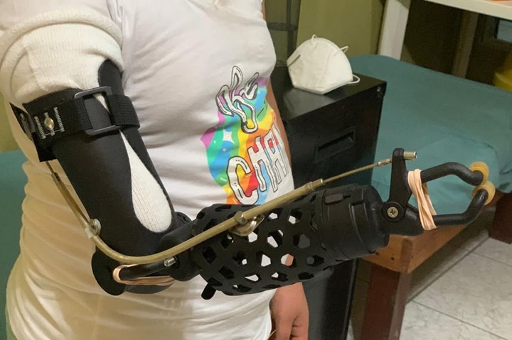 person with an arm prosthesis 