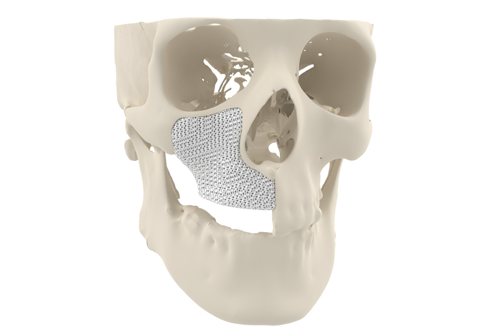 Cerhums 3D Printed Bone Approved for Patients in Europe Additive Manufacturing