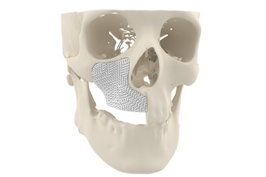 Cerhum’s MyBone is an implant 3D printed with a porous structure that enables ingrowth of blood vessels to treat patients with severe facial deformations. Photo Credit: Cerhum