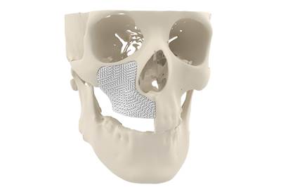Cerhum’s 3D Printed Bone Approved for Patients in Europe