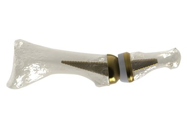 The metatarsophalangeal (MTP) toe joint replacement. Source: AddUp