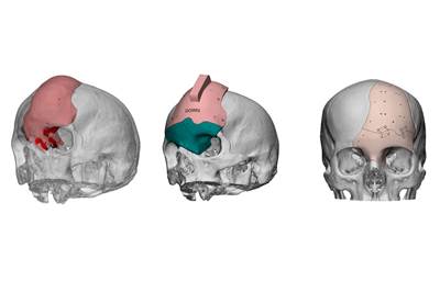 ArcomedLab Utilizes Biomedical 3D Printing for 700 Successful Craniomaxilofacial Implants in Latin America, and More News of Note