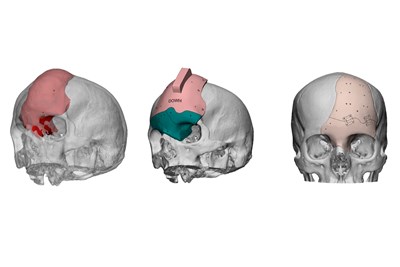 ArcomedLab Utilizes Biomedical 3D Printing for 700 Successful Craniomaxilofacial Implants in Latin America, and More News of Note