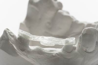 3D-printed continuous fiber dental reinforcements enter clinical trial