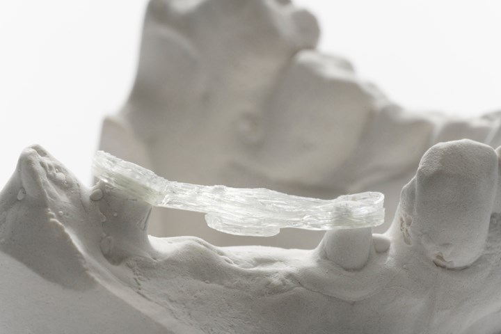 Hi-Fiber 3D-printed continuous fiber dental reinforcement.