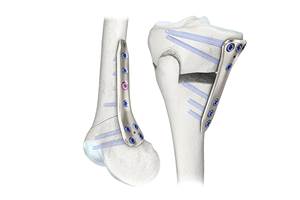 Inicia estudio clínico sobre tecnología de recubrimiento de plata para tratar fracturas