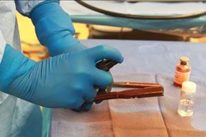 Recubrimiento antimicrobiano para implantes ortopédicos previene infecciones peligrosas
