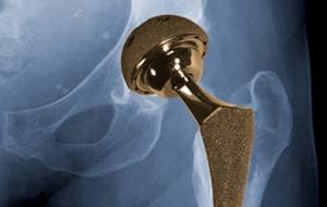 Study on Metal Hip Parts Finds Unusual Surface Coating